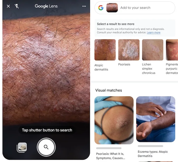 Google Lens menunjukkan opsi gambar untuk kemungkinan kondisi kulit. 